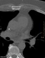 Calcified cardiac fibroma (Radiopaedia 39267-41519 Axial bone window 9).jpg