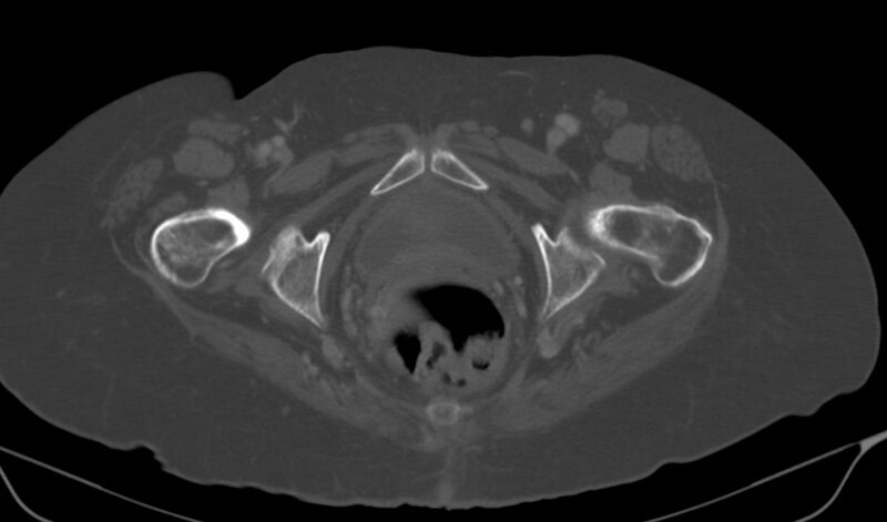 File:Calcified fibroids (Radiopaedia 20306-20228 Axial bone window 25).jpg