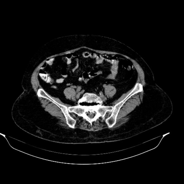 File:Calcified hydatid cyst (Radiopaedia 62000-70085 Axial non-contrast 79).jpg