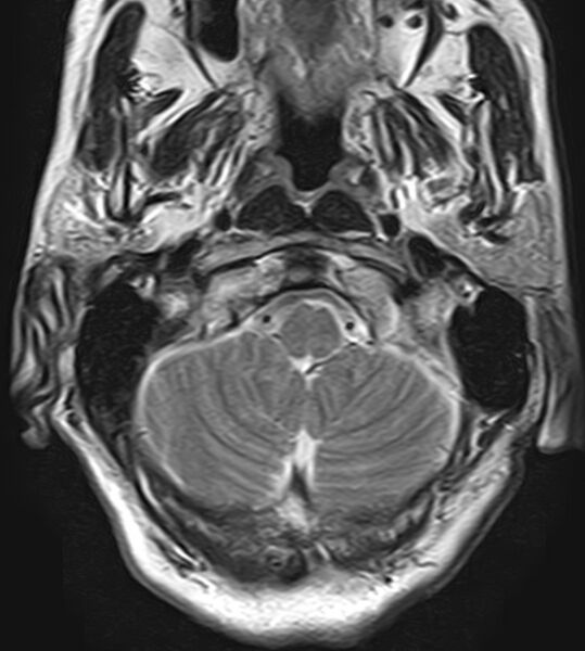 File:Calcified meningioma - cervical canal (Radiopaedia 70136-82468 Axial T2 1).jpg