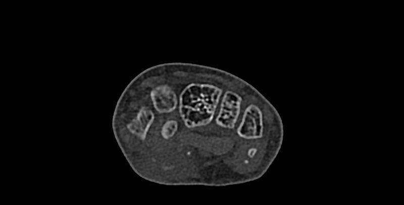 File:Calcifying aponeurotic fibroma (Radiopaedia 88423-105064 Axial bone window 81).jpg