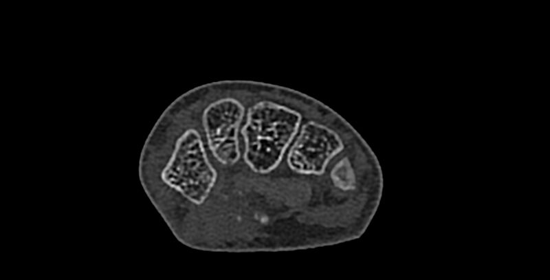 File:Calcifying aponeurotic fibroma (Radiopaedia 88423-105064 Axial bone window 95).jpg