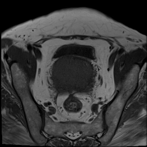 File:Cancer cervix - stage IIb (Radiopaedia 75411-86615 Axial T1 19).jpg