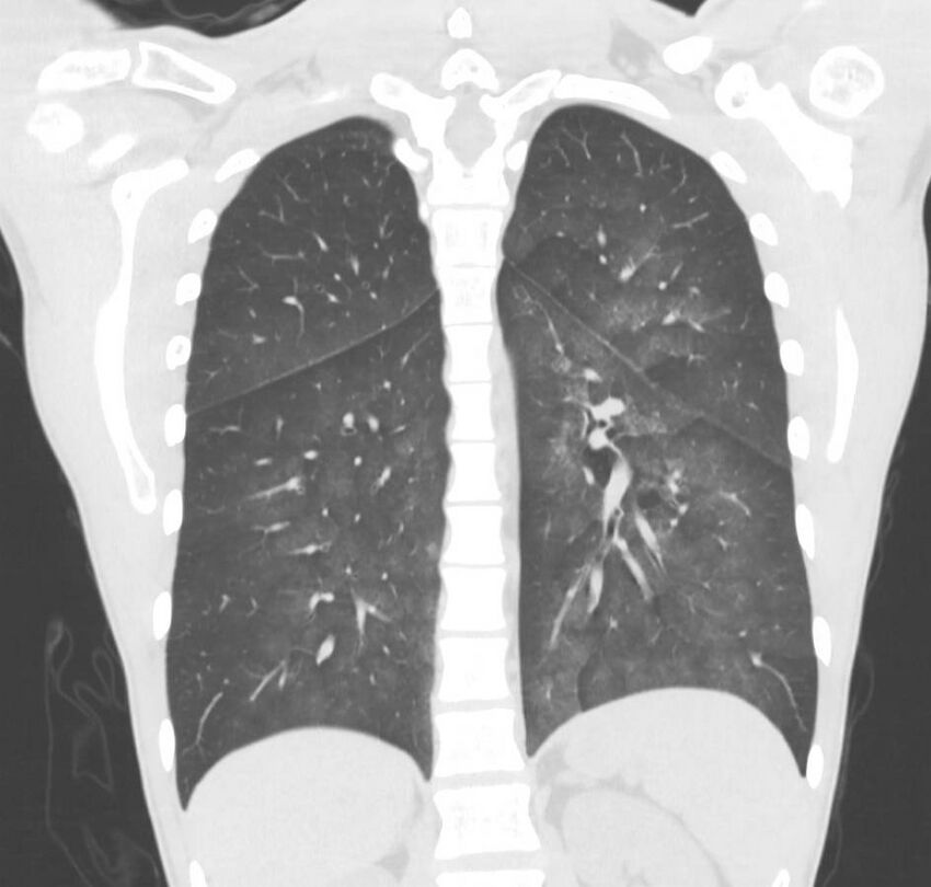 Cannabis-induced diffuse alveolar hemorrhage (Radiopaedia 89834-106946 Coronal lung window 29).jpg