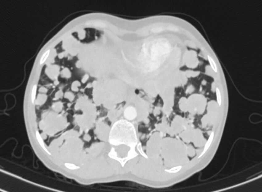 Cannonball metastases from breast cancer (Radiopaedia 91024-108569 Axial lung window 82).jpg