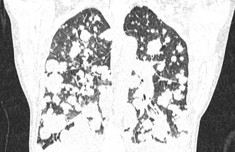 File:Cannonball metastases from breast cancer (Radiopaedia 91024-108569 Coronal lung window 95).jpg