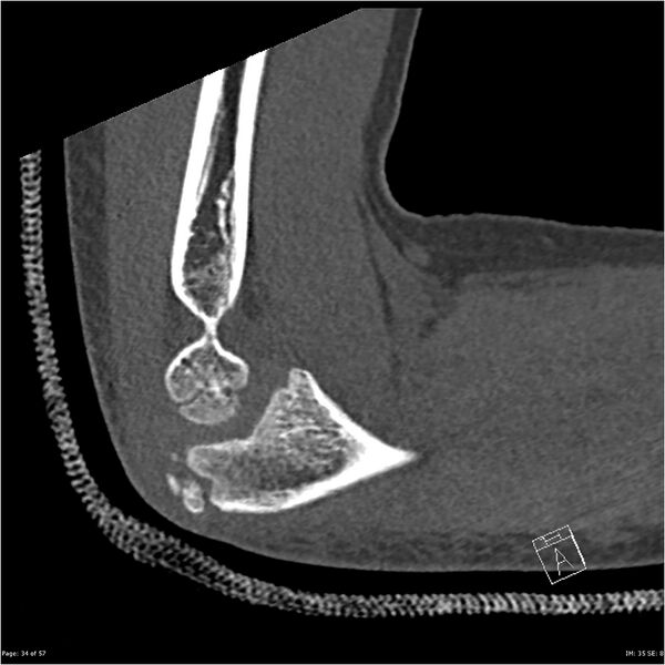 File:Capitellum fracture (Radiopaedia 23352-23426 Sagittal bone window 34).jpg