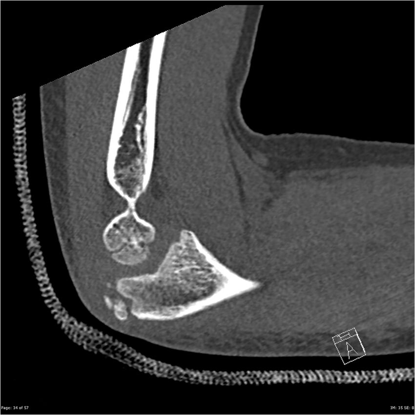 Capitellum fracture (Radiopaedia 23352-23426 Sagittal bone window 34).jpg