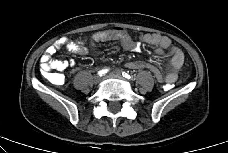 File:Carcinoid mesenteric tumor complicated by chylous ascites (Radiopaedia 76312-88926 A 47).jpg