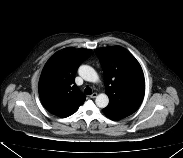 File:Carcinoid tumor with hepatic metastases (Radiopaedia 22651-22670 C 11).jpg
