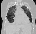Cardiogenic pulmonary edema (Radiopaedia 29213-29609 Coronal lung window 26).jpg