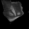 Cardiogenic pulmonary edema (Radiopaedia 29213-29609 Coronal non-contrast 44).jpg