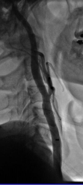 File:Carotid angioplasty (Radiopaedia 16766-16479 D 1).jpg