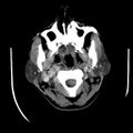 Carotid body tumor (Radiopaedia 27890-28124 A 8).jpg