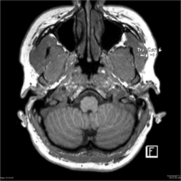 File:Cavernous malformation (cavernous angioma or cavernoma) (Radiopaedia 36675-38237 Axial T1 12).jpg