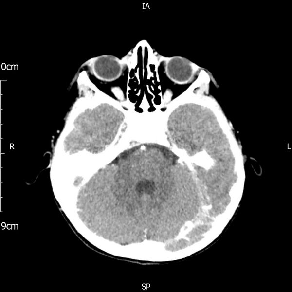 File:Cavernous sinus thrombosis (Radiopaedia 79414-92510 Axial Brain 74).jpg
