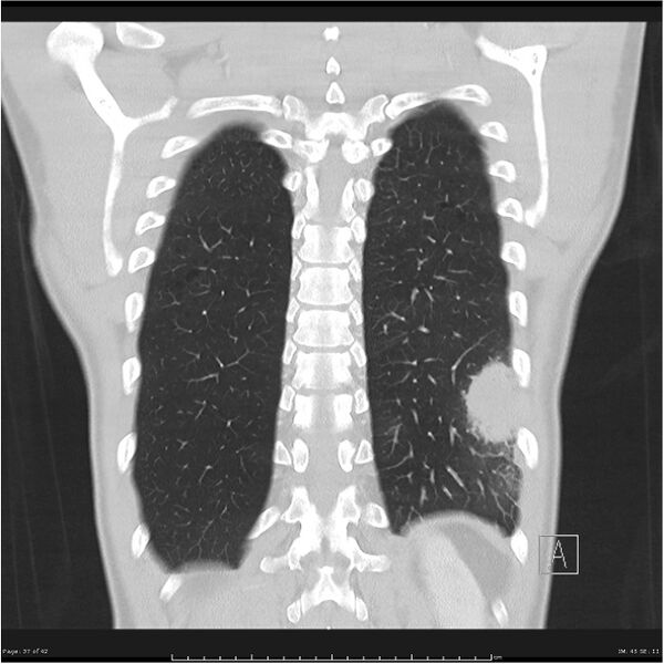 File:Cavitating lung cancer (Radiopaedia 25796-25945 lung window 37).jpg