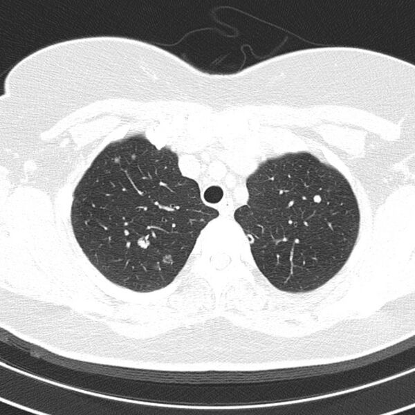 File:Cavitating pulmonary metastases (Radiopaedia 17796-17555 Axial lung window 2).jpg