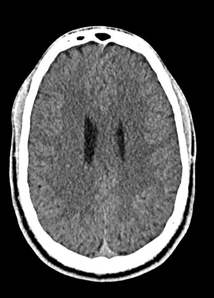 File:Cavum septum pellucidum and cavum vergae (Radiopaedia 77797-90060 Axial Brain Window 68).jpg