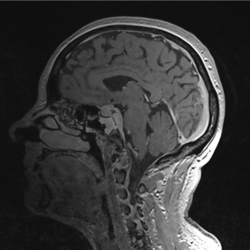 Central base of skull meningioma (Radiopaedia 53531-59549 Sagittal T1 C+ 29).jpg