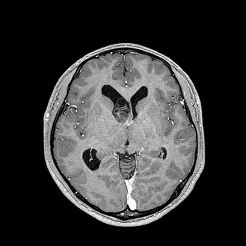 Central neurocytoma (Radiopaedia 79320-92380 Axial T1 C+ 120).jpg