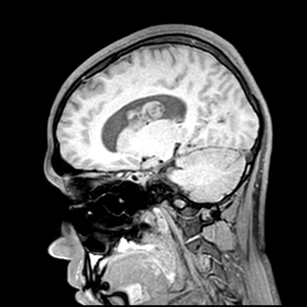 File:Central neurocytoma (Radiopaedia 79320-92380 Sagittal T1 106).jpg