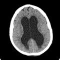 Cerebellar abscess secondary to mastoiditis (Radiopaedia 26284-26412 Axial non-contrast 95).jpg