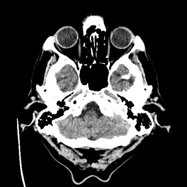 File:Cerebellar hemorrhage (Radiopaedia 27193-27359 Axial non-contrast 5).jpg