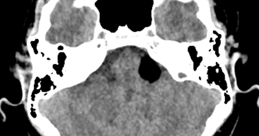 Cerebellopontine angle lipoma (Radiopaedia 57303-64242 B 30).jpg