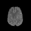 Cerebral abscess post cardiac surgery (Radiopaedia 27244-27420 Axial DWI 15).jpg