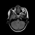 Cerebral abscess post cardiac surgery (Radiopaedia 27244-27420 Axial FLAIR 5).jpg