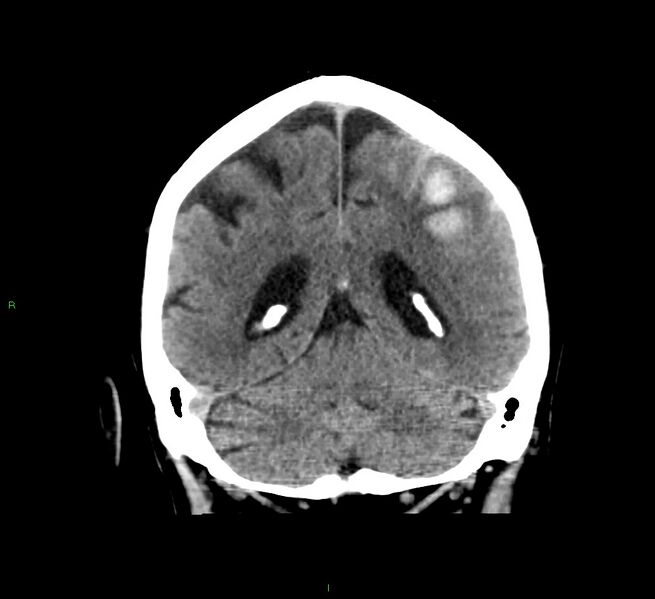 File:Cerebral amyloid angiopathy-associated lobar intracerebral hemorrhage (Radiopaedia 58376-65511 Coronal non-contrast 23).jpg