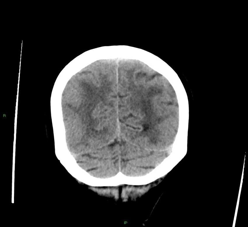 Cerebral amyloid angiopathy-associated lobar intracerebral hemorrhage (Radiopaedia 58378-65516 Coronal non-contrast 15).jpg