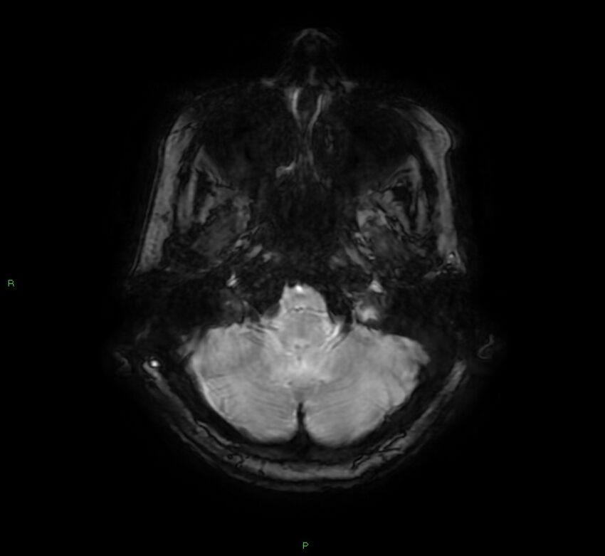 Cerebral amyloid angiopathy-associated lobar intracerebral hemorrhage (Radiopaedia 58378-65517 Axial SWI 12).jpg