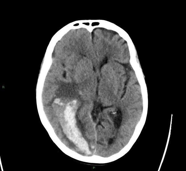 File:Cerebral amyloid angiopathy-associated lobar intracerebral hemorrhage (Radiopaedia 58563-65727 Axial non-contrast 30).jpg