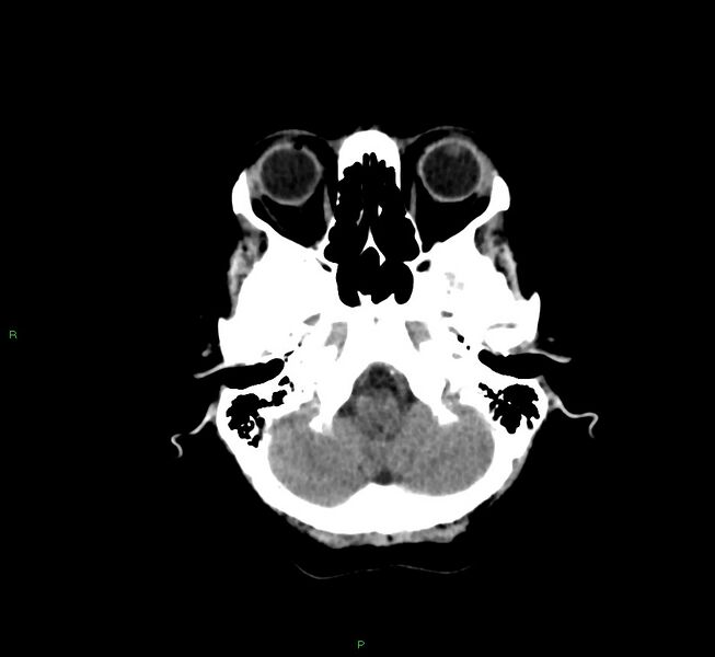 File:Cerebral amyloid angiopathy-associated lobar intracerebral hemorrhage (Radiopaedia 58757-65978 Axial non-contrast 42).jpg