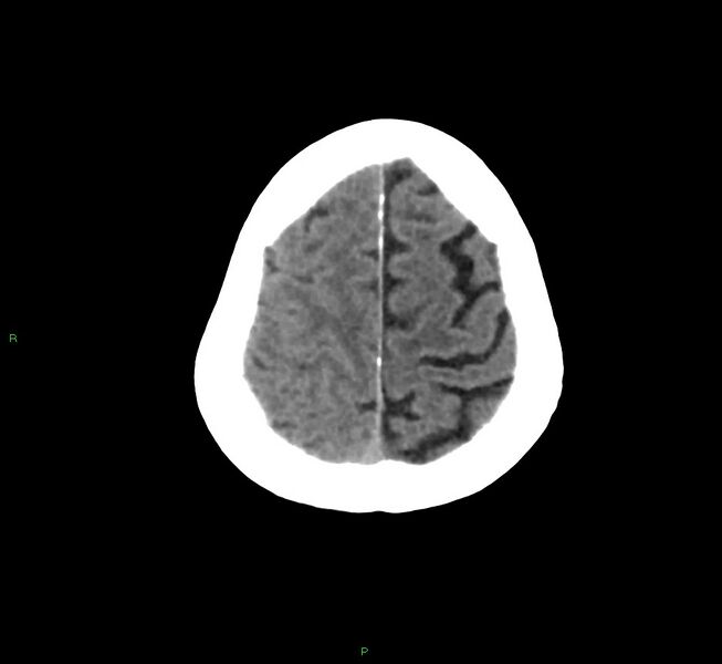 File:Cerebral amyloid angiopathy-associated lobar intracerebral hemorrhage (Radiopaedia 58758-65980 Axial non-contrast 9).jpg