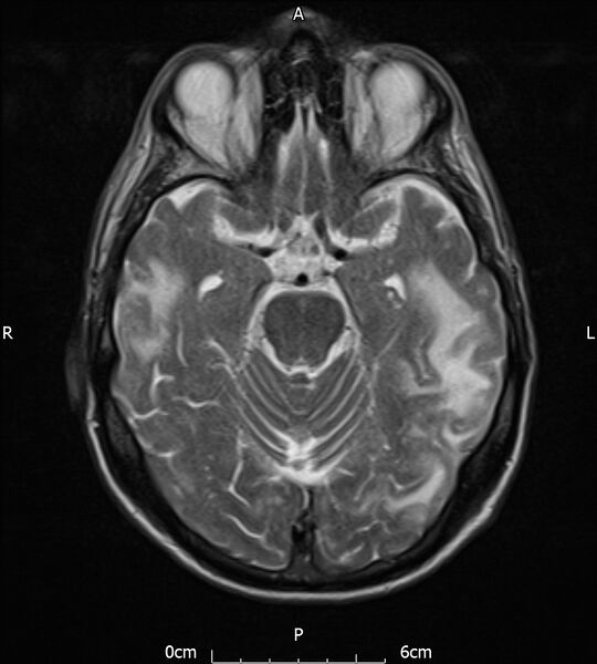File:Cerebral amyloid angiopathy related inflammation (Radiopaedia 72772-83415 Axial T2 9).jpg