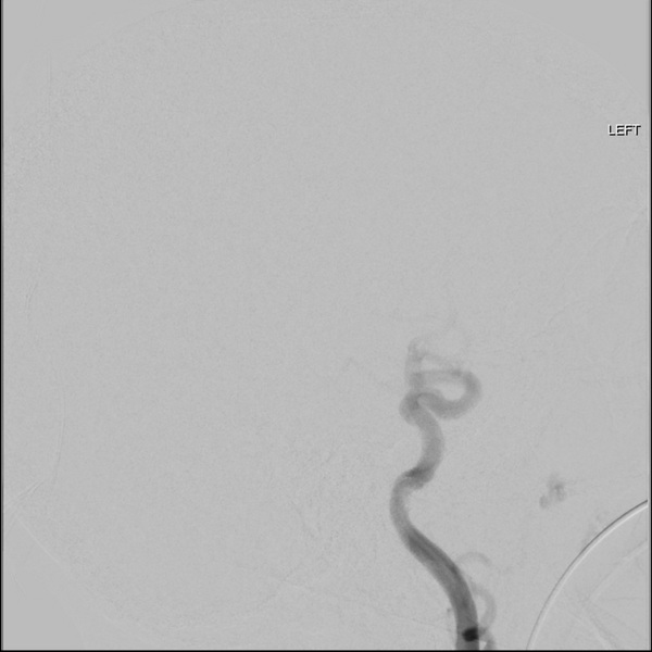 File:Cerebral arteriovenous malformation with lobar hemorrhage (Radiopaedia 44725-48513 LT CCA IC 32).png