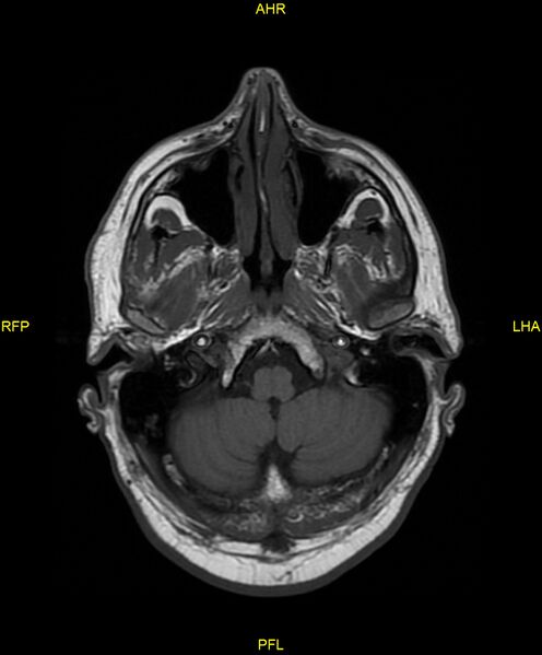 File:Cerebral autosomal dominant arteriopathy with subcortical infarcts and leukoencephalopathy (CADASIL) (Radiopaedia 86108-102054 Axial T1 5).jpg