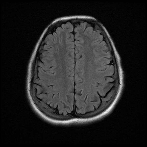 File:Cerebral cavernous malformation (Radiopaedia 44301-47942 Axial FLAIR 16).jpg