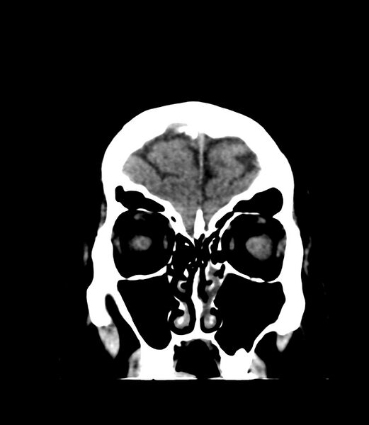 File:Cerebral dural venous sinus thrombosis (Radiopaedia 86514-102575 Coronal non-contrast 3).jpg