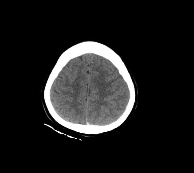 File:Cerebral fat embolism (Radiopaedia 37510-39362 Axial non-contrast 27).jpg