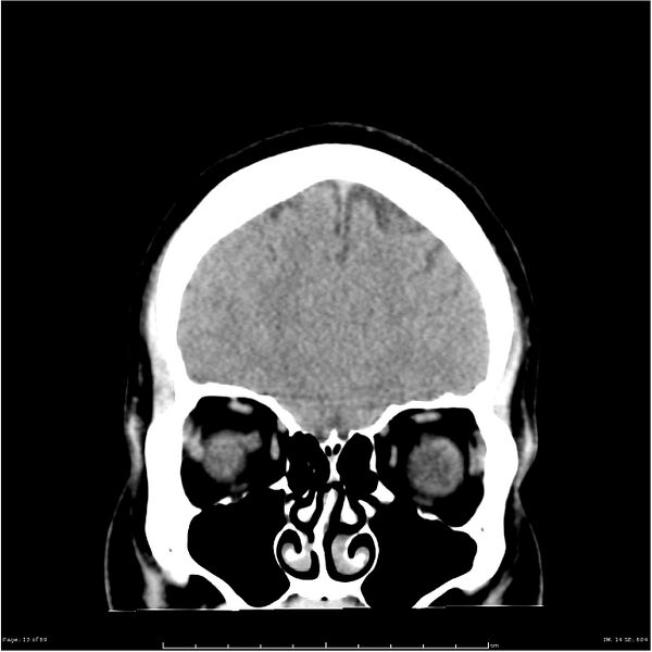 File:Cerebral hemorrhage secondary to arteriovenous malformation (Radiopaedia 33497-34561 Coronal non-contrast 4).jpg