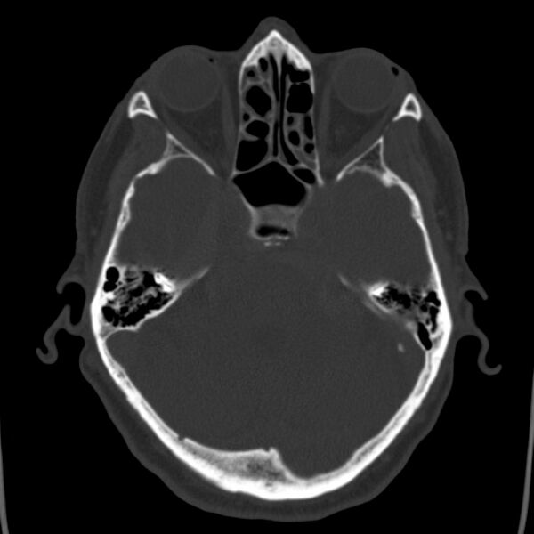 File:Cerebral hemorrhagic contusions (Radiopaedia 23145-23188 Axial bone window 16).jpg