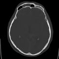 Cerebral hemorrhagic contusions (Radiopaedia 23145-23188 Axial bone window 26).jpg