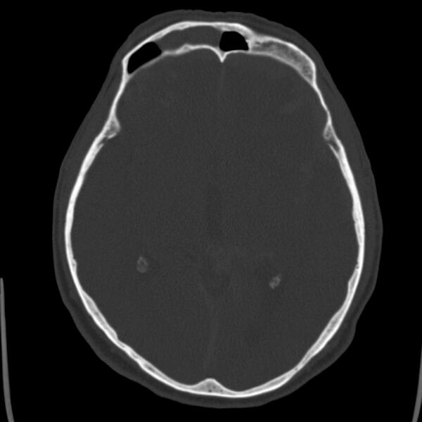 File:Cerebral hemorrhagic contusions (Radiopaedia 23145-23188 Axial bone window 26).jpg