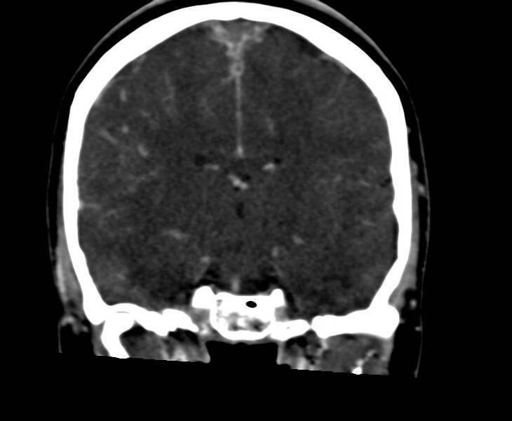 File:Cerebral venous sinus thrombosis (Radiopaedia 59224-66646 Coronal C+ delayed 40).jpg