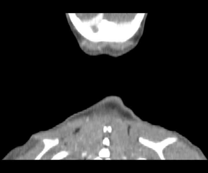 File:Cervical cystic lymphangioma (Radiopaedia 63655-72332 Coronal + contrast 34).jpg
