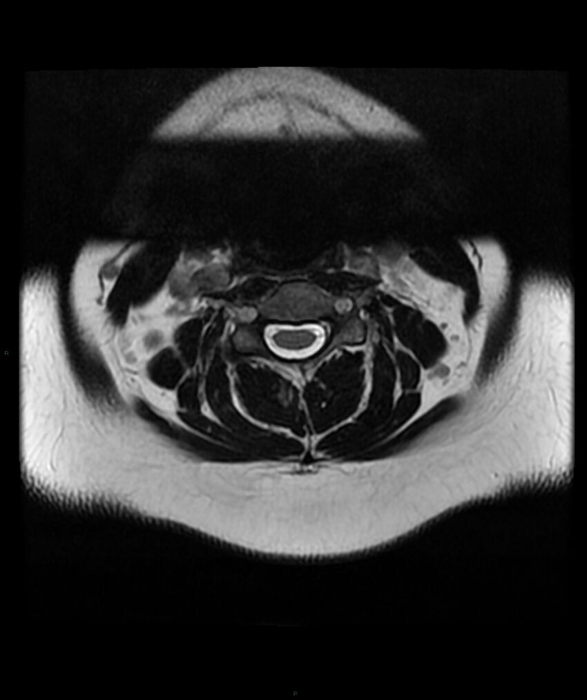Cervical disc prolapse (Radiopaedia 80258-93598 Axial T2 15).jpg